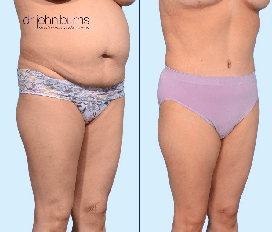 Case 8- 45 Degree View- Before and After Tummy Tuck with LIpo 360, Dallas, Texas