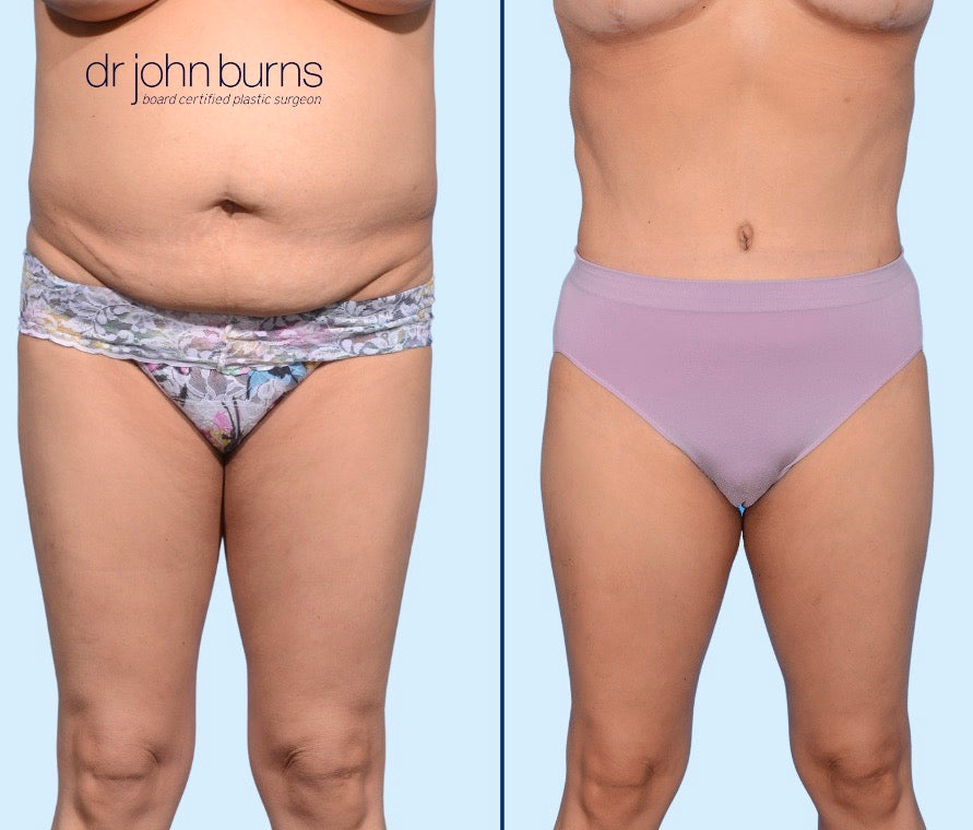 Case 8- Front View- Before and After Tummy Tuck with LIpo 360, Dallas, Texas