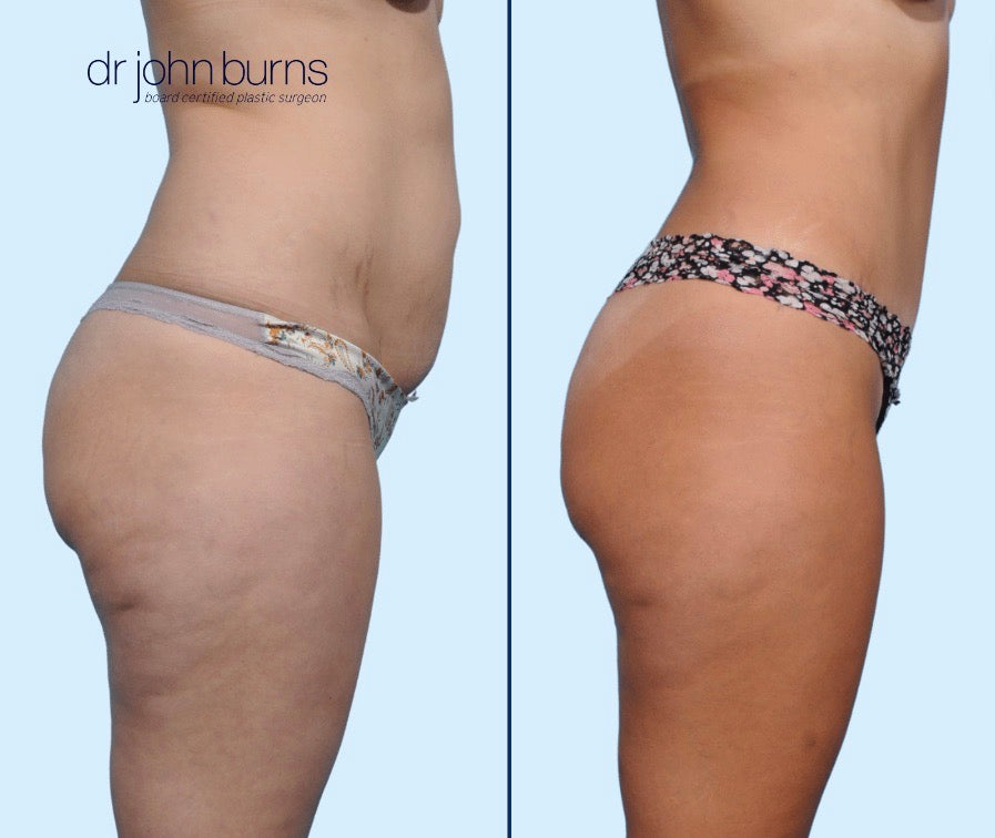 Case 9- Profile View- Before & After Mommy Makeover Tummy Tuck with Liposuction