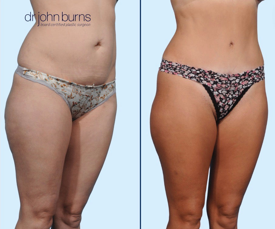 Case 9- 45 Degree View- Before & After Mommy Makeover Tummy Tuck with Liposuction