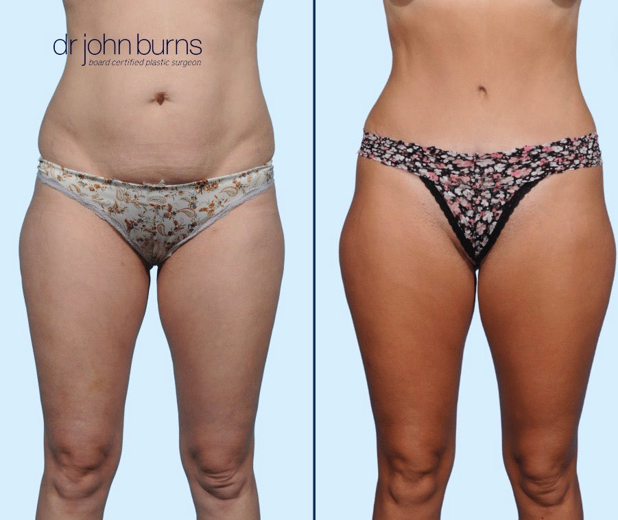 Case 9- Front View- Before & After Mommy Makeover Tummy Tuck with Liposuction