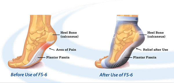 Before and after use of compression sleeve for plantar fasciitis