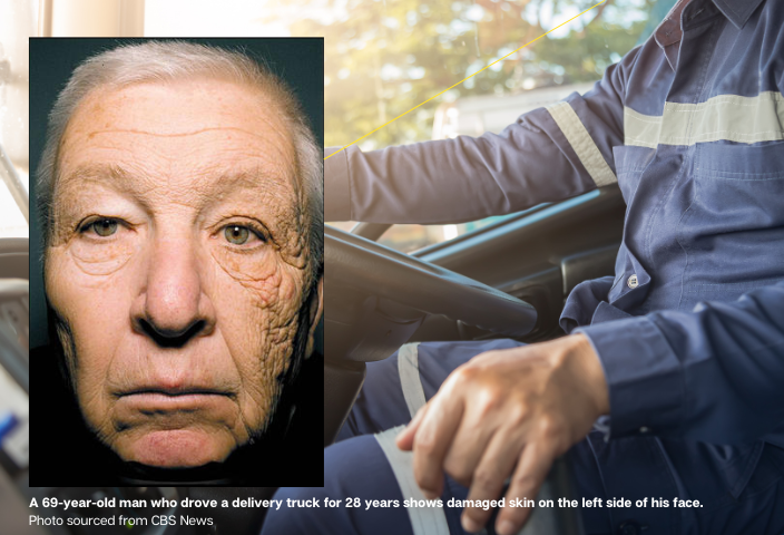 A 69-year-old man who drove a delivery truck for 28 years shows damaged skin on the left side of his face.