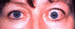 thyroid and dry eye