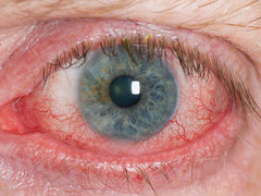 What Are Symptoms Of Dry Eye Disease?