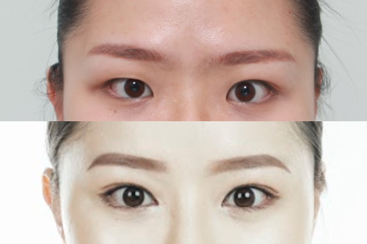 how much does double eyelid surgery cost in korea