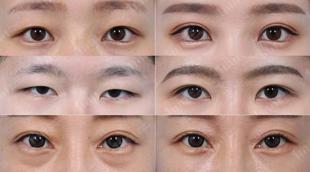 In addition to eye surgery and double eyelid surgery in Incheon, there are many different types of surgery.