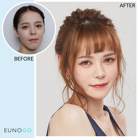 korean plastic surgery before and after jaw