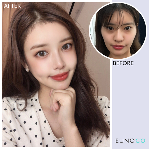 korean plastic surgery before and after jaw