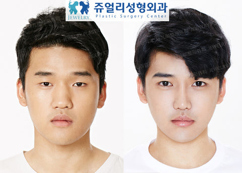 double eyelid surgery men