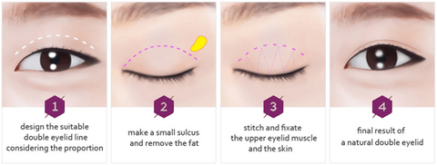 double eyelid incision method