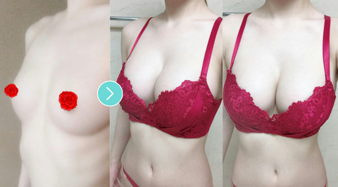 The Latest Mentor Breast Implants, And How To Avoid Dimples And