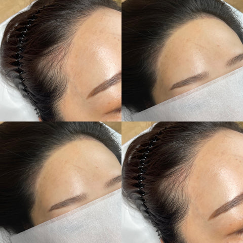 A natural hairline semipermanent procedure