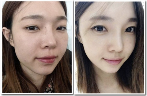 baby face injection korea