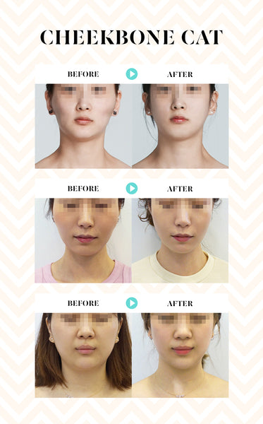 Non surgical ways to achieve the perfect V-line face shape – Eunogo Non surgical ways to achieve the perfect V-line face shape – Eunogo