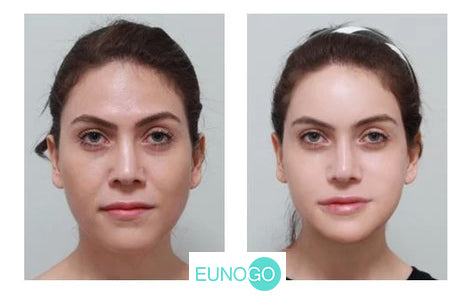 Korean Plastic Surgery Ensuring Safe and Sleek V-Line Facial Contouring  Surgery