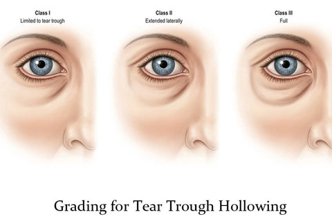 How to get rid of dark circles and hollow eyes  Dr Deepak P Devakar   YouTube