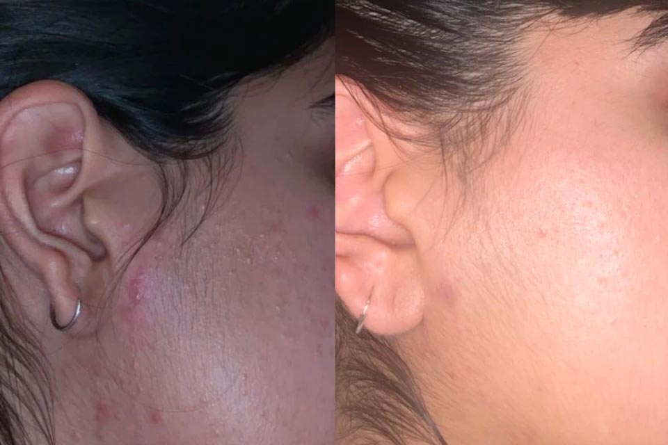 Comparison of acne-ridden skin before and after using Creme Cleanser for Most skin