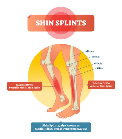 posterior shin splints bumps