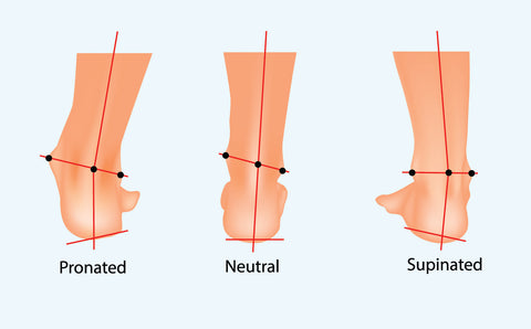 overpronation