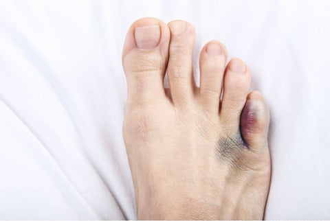 bruised toe