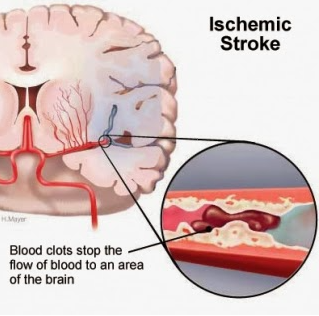 Vascular Dementia - Ischemic Stroke