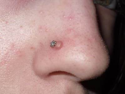 What is this? It's a fairly large, squishy bump that first appeared about  3mo after getting my 2nds pierced. : r/piercing