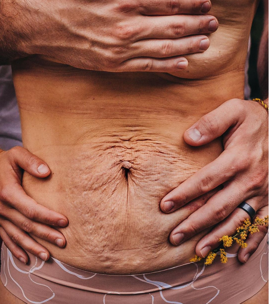 Picture of womans belly after birth