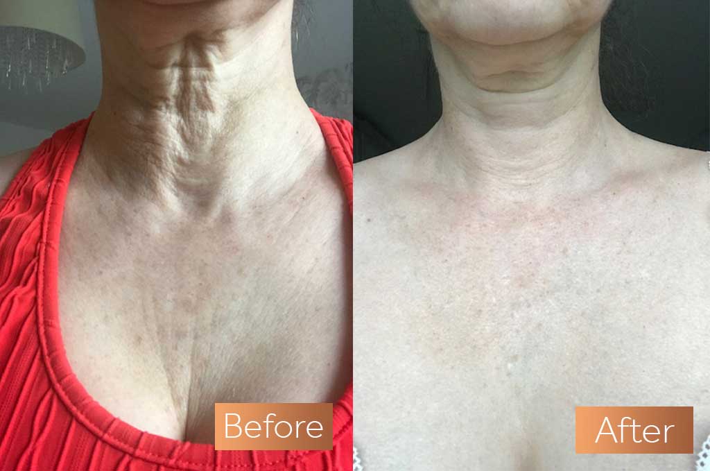 Absolute Collagen supplement before and after neck decolletage
