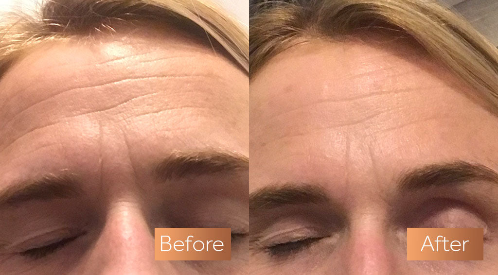 4 YEAR UPDATE of taking COLLAGEN PEPTIDES with Realistic Results and  BeforeAfter PICTURES collagen  YouTube
