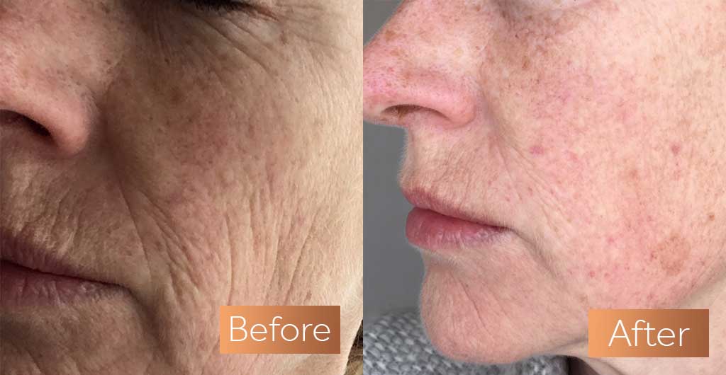 Absolute Collagen supplement antes e depois das rugas da pele sagrar