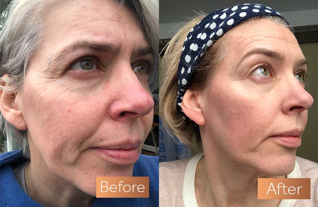 Absolute Collagen supplement before and after skin wrinkles sag