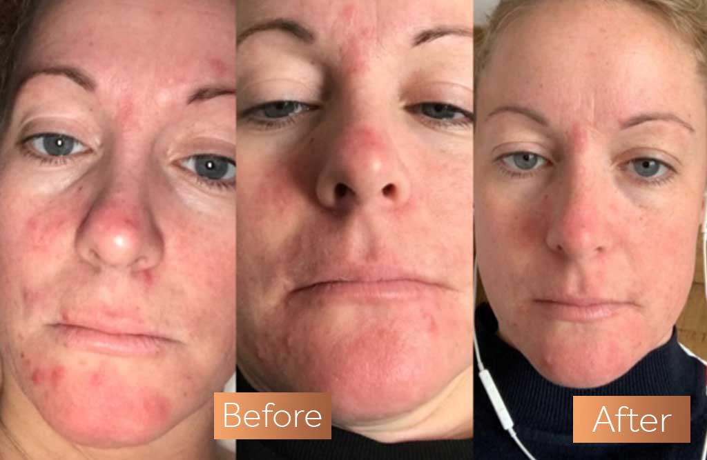 Absolute Collagen supplement before and after skin rosacea acne