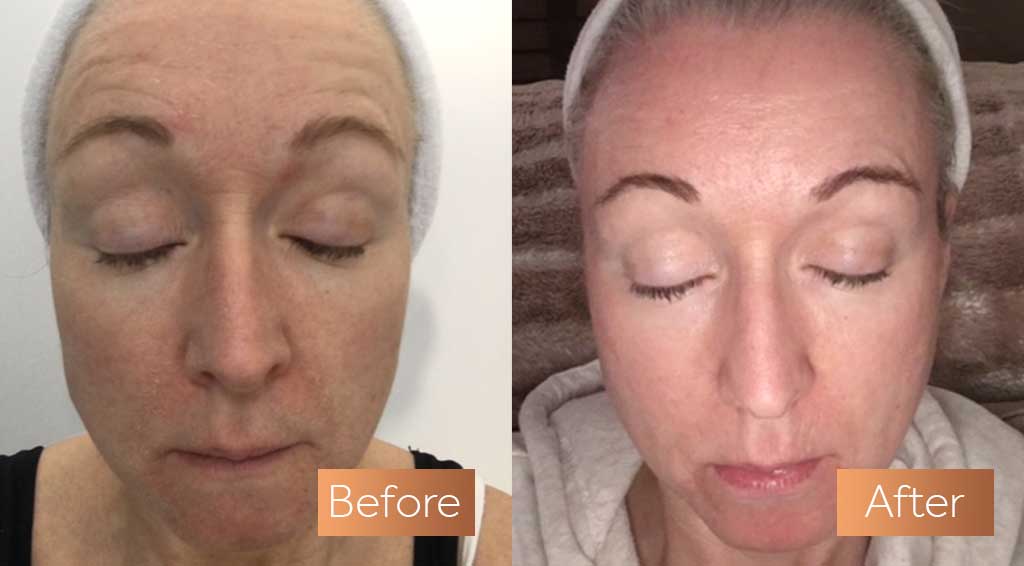 Absolute Collagen supplement before and after skin rugas flacidez