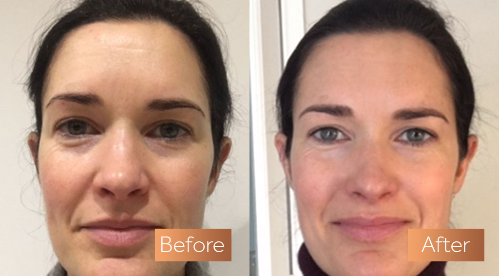 Absolute Collagen supplement before and after skin wrinkles sag