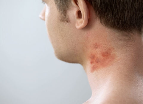 Man with red, dry patches on neck. 