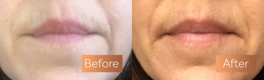 Absolute Collagen supplement before and after lips plump smile lines