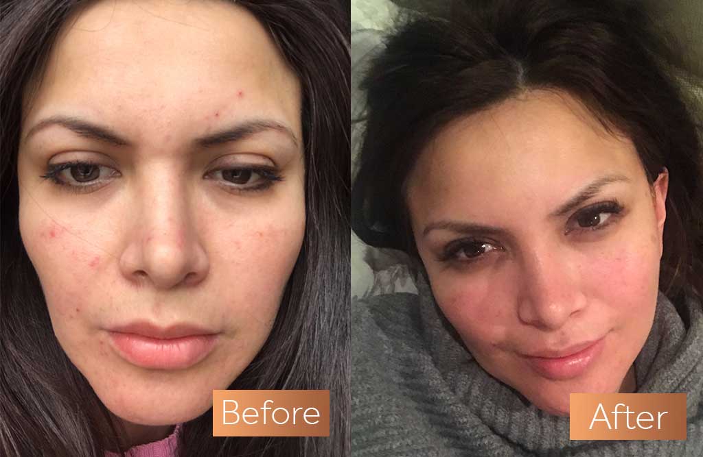 Absolute Collagen supplement before and after skin rosacea acne