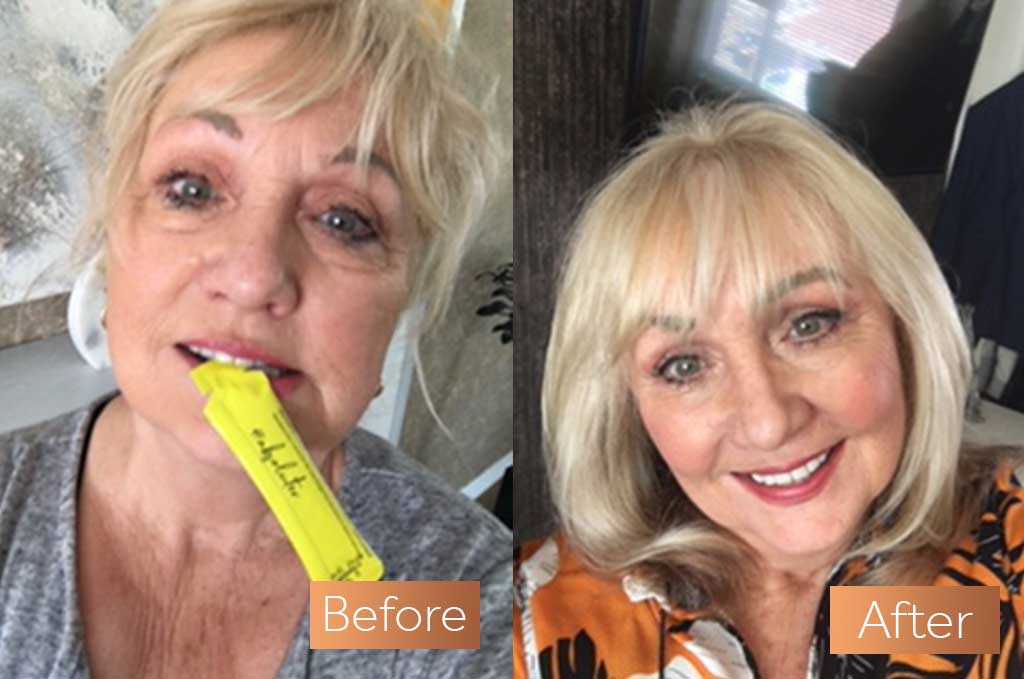 Absolute Collagen supplement antes e depois das rugas cutâneas flacidez