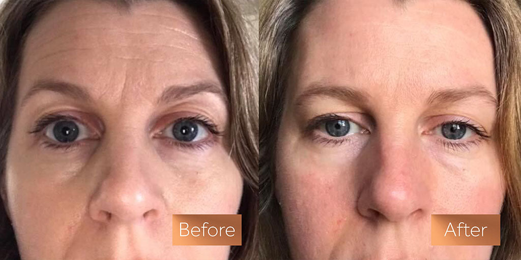 Absolute Collagen supplement before and after skin wrinkles sag