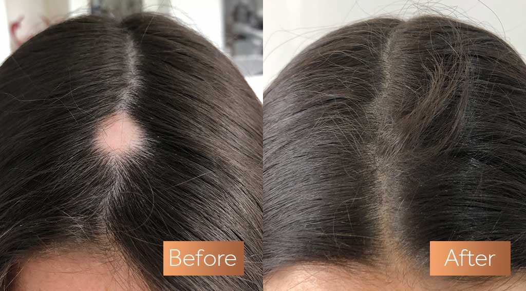 Absolute Collagen supplement before and after hair thinning alopecia frizzy