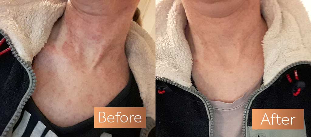 Absolute Collagen supplement before and after neck decolletage