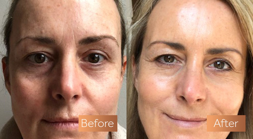 Absolute Collagen supplement before and after eyes crows feet puffiness