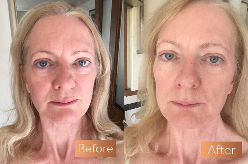 Absolute Collagen supplement before and after skin wrinkles sag