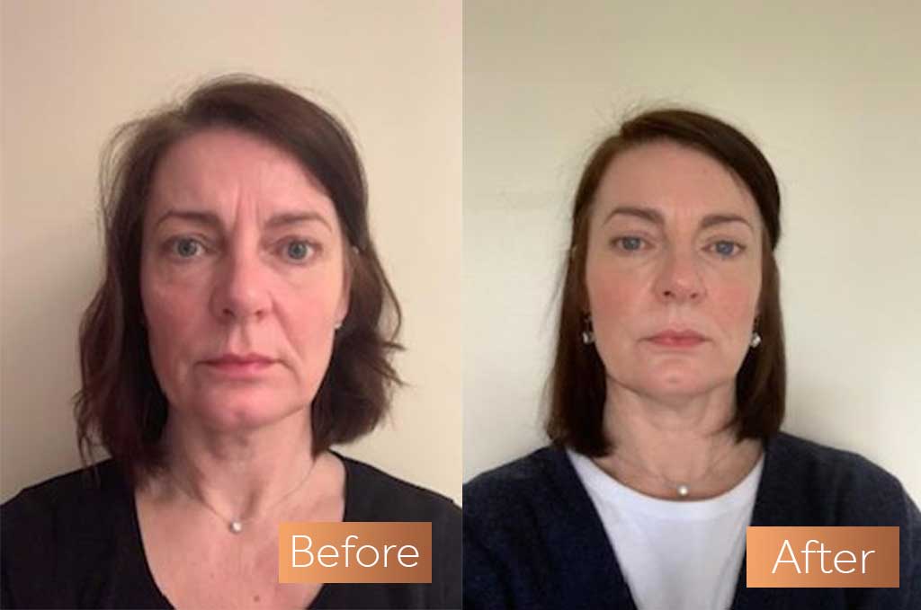 Absolute Collagen supplement antes e depois das rugas cutâneas sagra