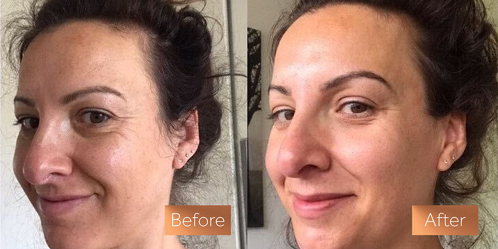 Absolute Collagen supplement before and after skin wrinkles sag