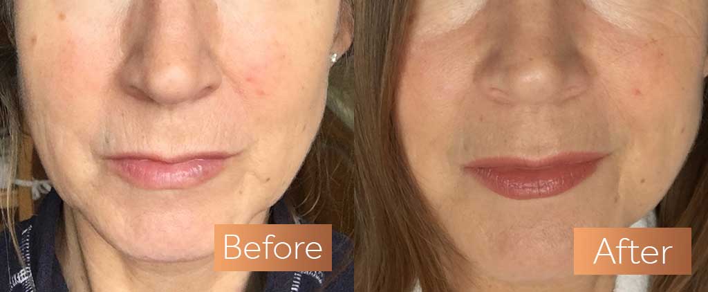 Absolute Collagen supplement before and after lips plump smile lines