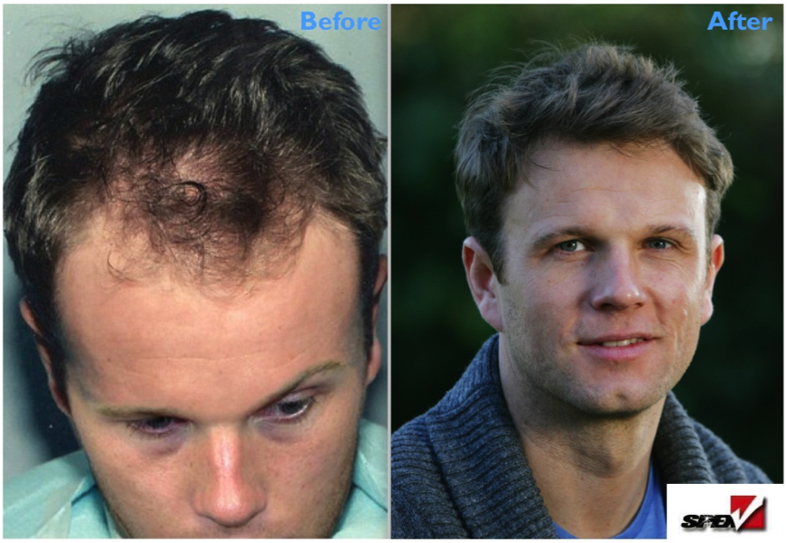 Spex before and after hair loss treatment 