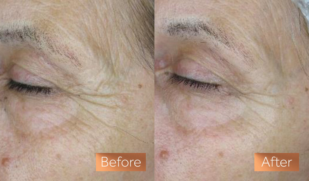 Two photos showing a close up of a white woman with wrinkled skin before using Maxerum serum and reduced wrinkles after using the product