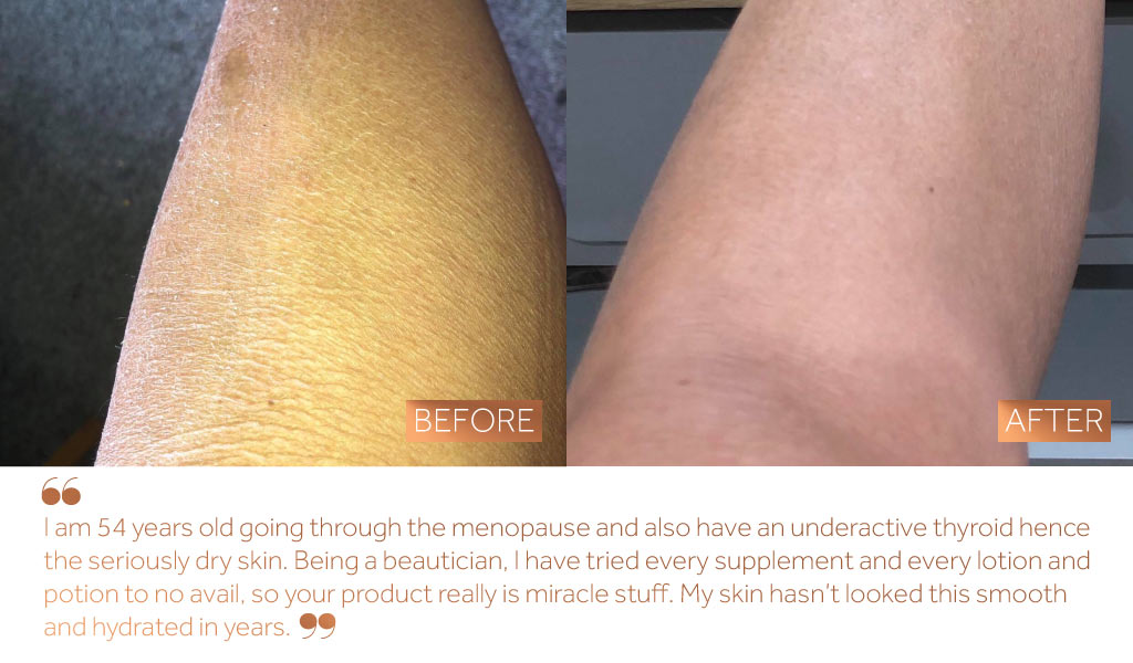 Before and after photo of a woman’s dry skin on her leg following 6 weeks of Absolute Collagen consumption. 